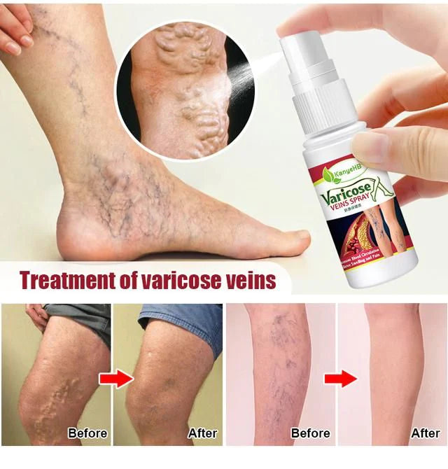 Varicose Veins Treatment Spray 🌿100% Herbal🌿