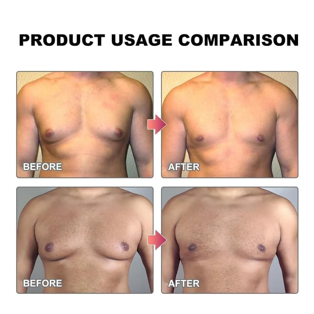 Bee Venom Gynecomastia Heating Oil - Buy 1 Get 1 FREE