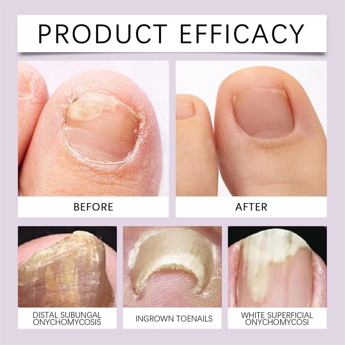 BeeVenom Nail Soothing Serum - Buy 1 Get 1 FREE