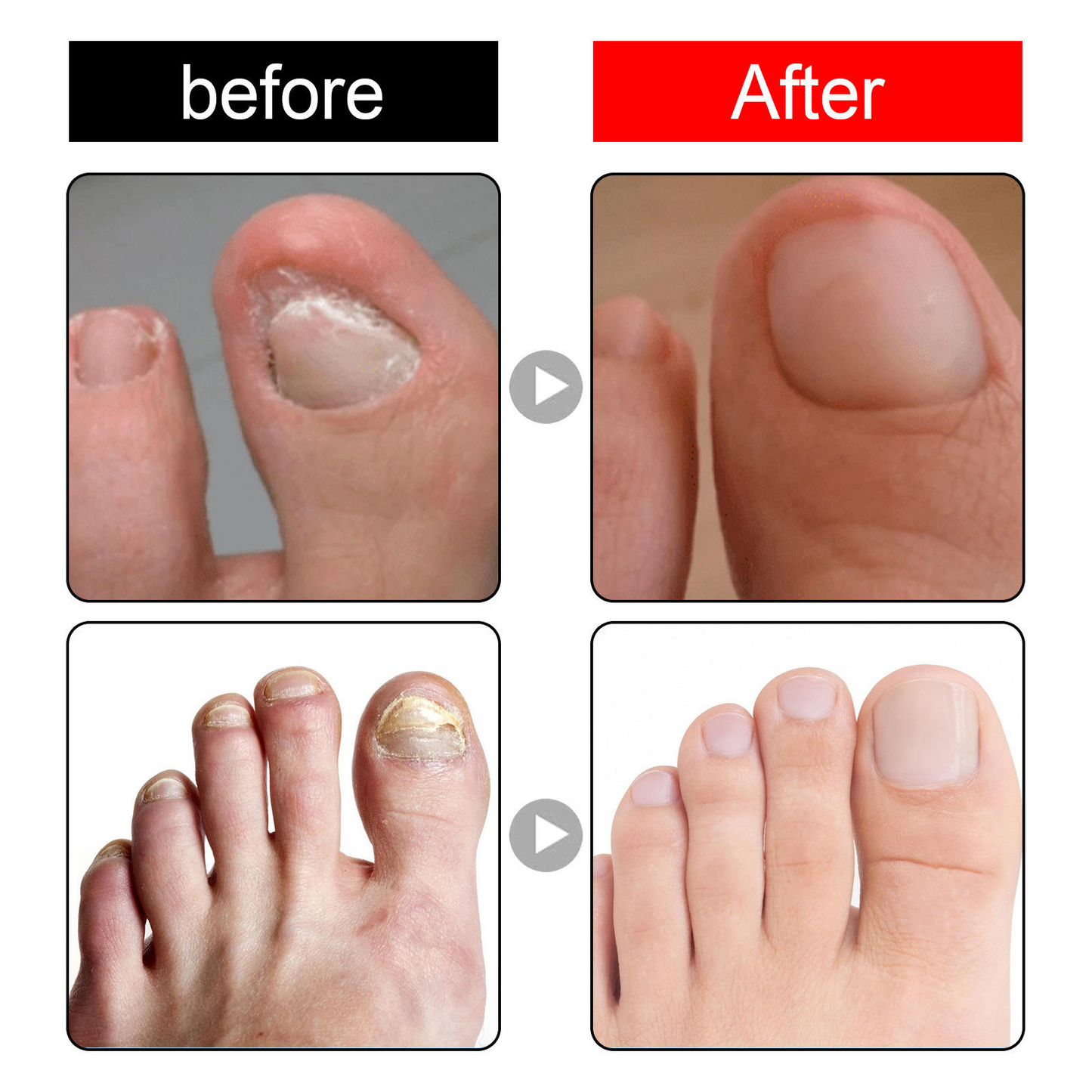 Toenail Drops Nail Repair Oil (BUY 1 GET 1 FREE๐ฅ๐ฅ)
