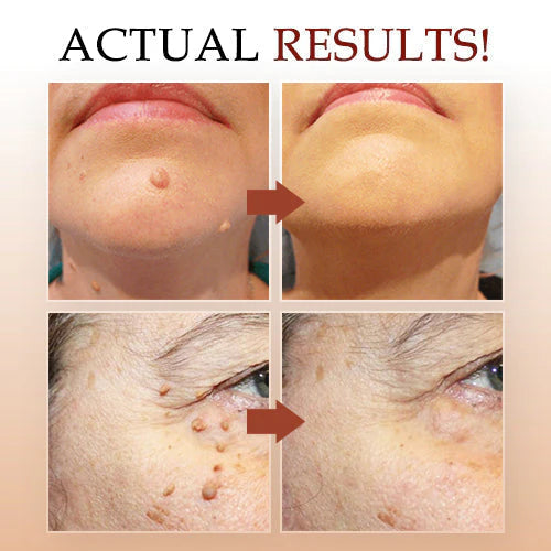 LOVILDS™ Warts & Tags Remover (Buy 1 Get 1 Free🔥🔥)