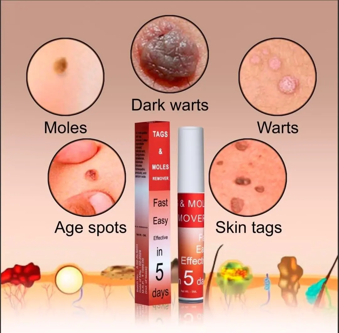 LOVILDS™ Warts & Tags Remover (Buy 1 Get 1 Free🔥🔥)