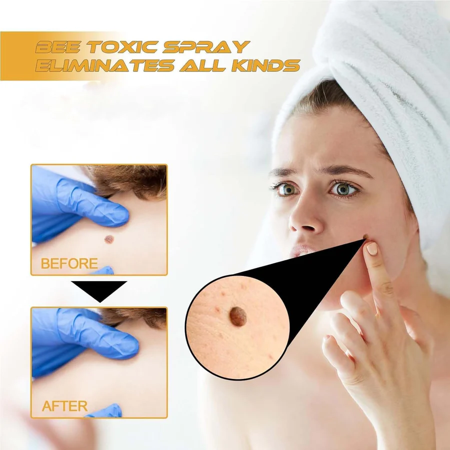Bee Venom Skin Tag & Wart Remover Spray