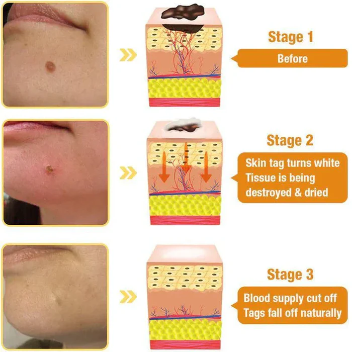Bee Venom Skin Tag & Wart Remover Spray