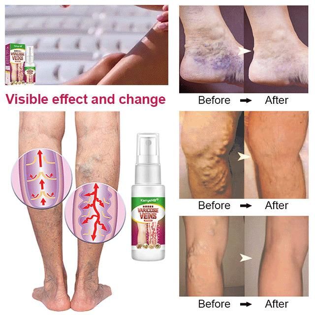 Varicose Veins Treatment Spray 🌿100% Herbal🌿