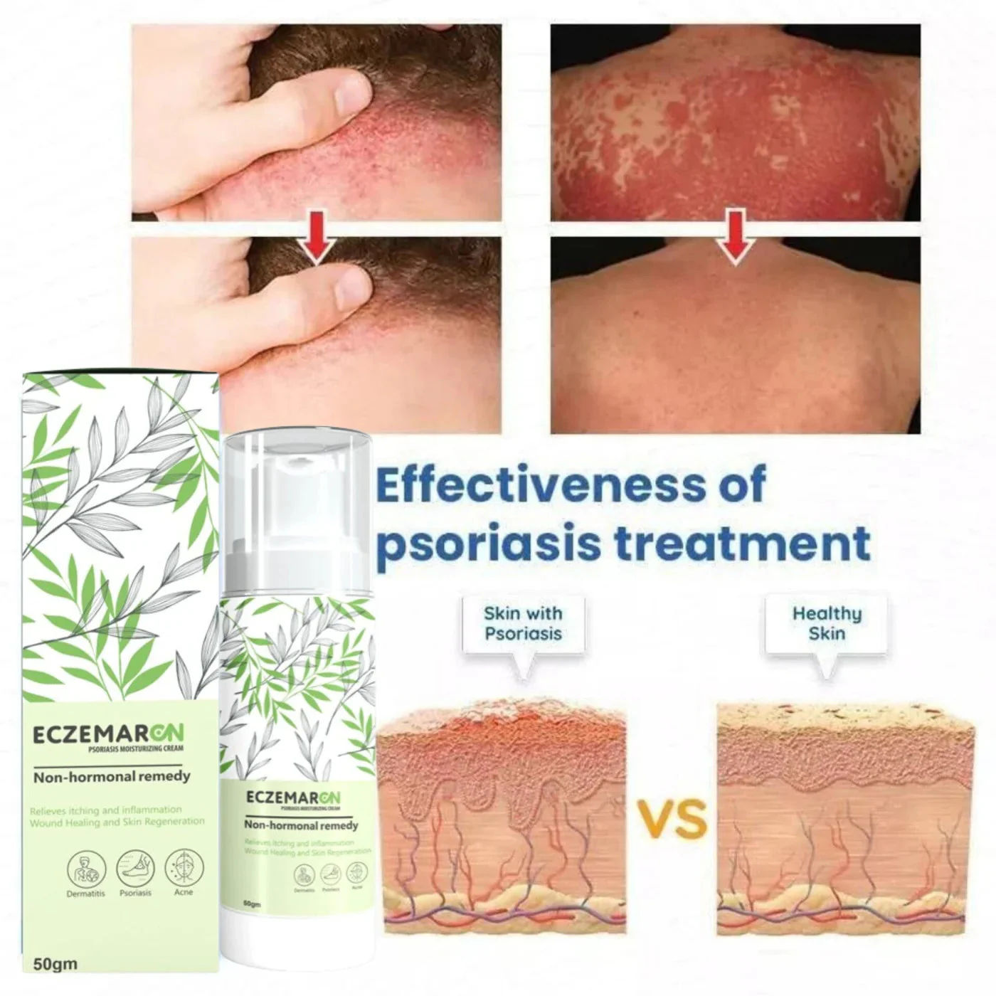 Eczemaron Anti-Fungal Spray - Instant Relief from Itching & Infection (Buy 1 Get 1 FREE🔥🔥)