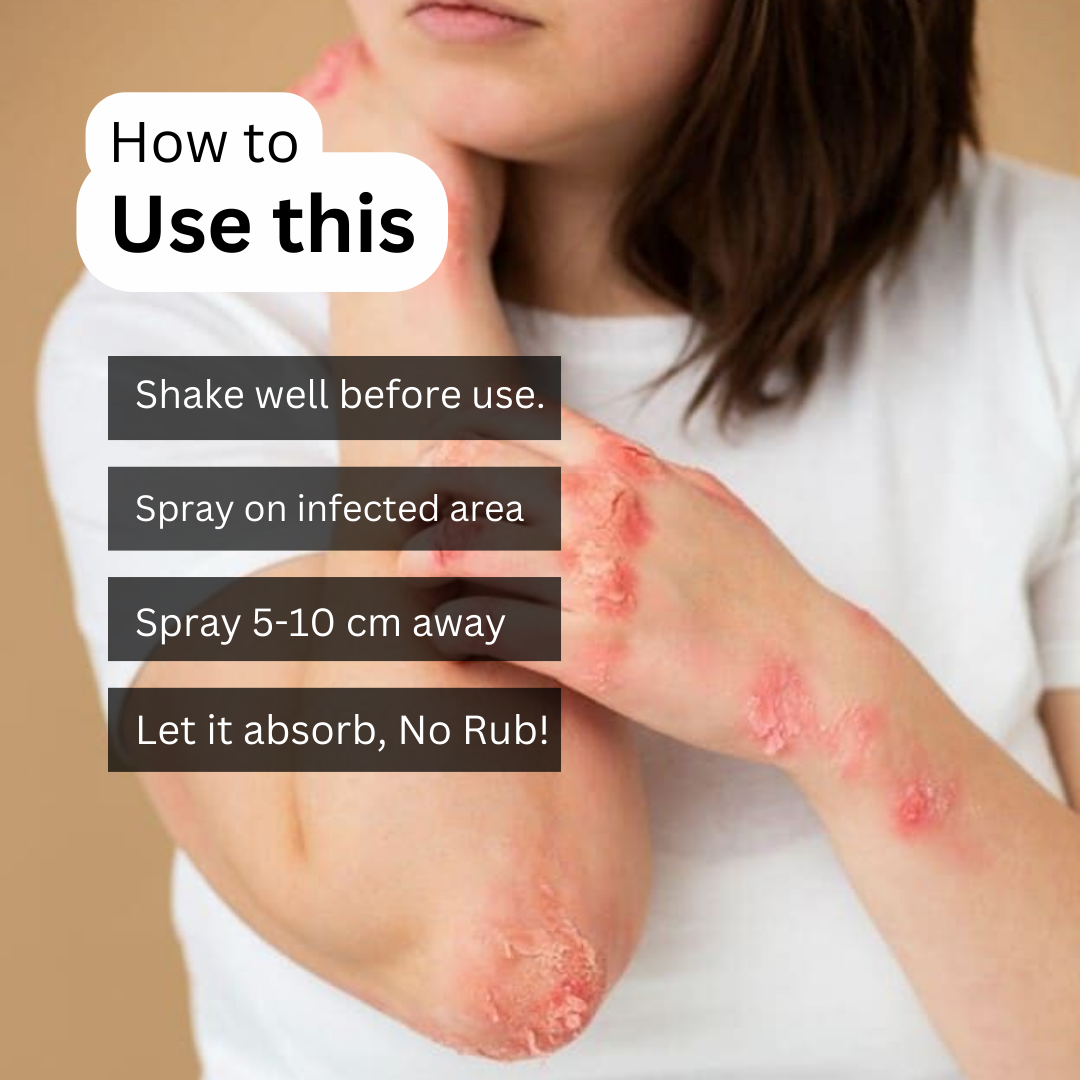 ItchXpert Anti Fungal Spray - Buy 1 Get 1 FREE