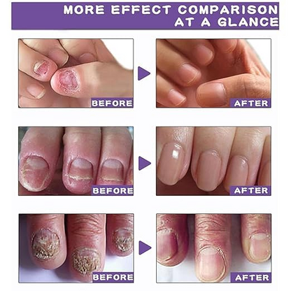Nail Repair & Growth Herbal Serum Spray - (Buy 1 Get 1 FREE🔥🔥)