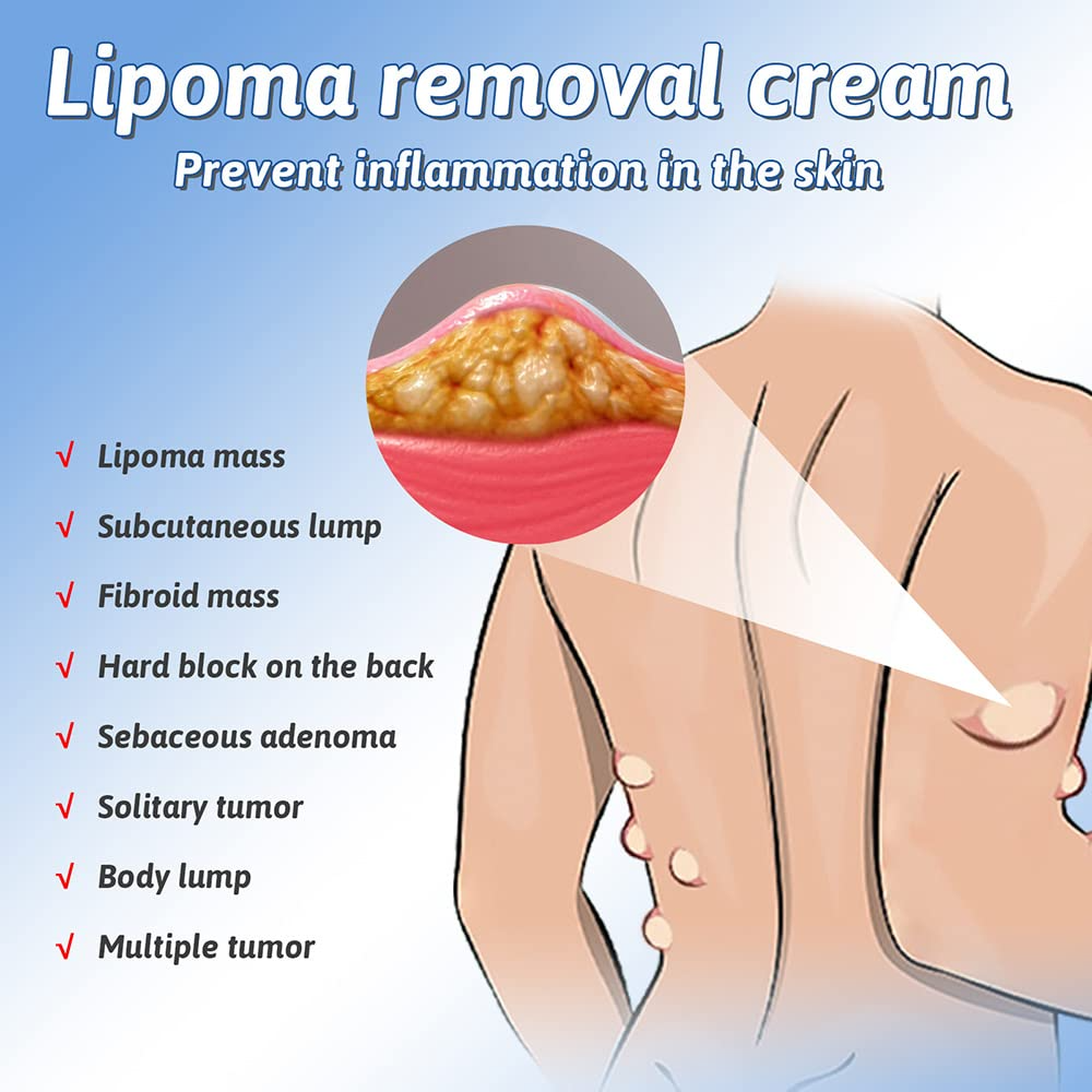 QB Herbal Lipoma Removal Cream