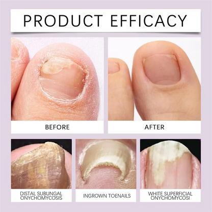 BeeVenom Nail Soothing Serum - Buy 1 Get 1 FREE