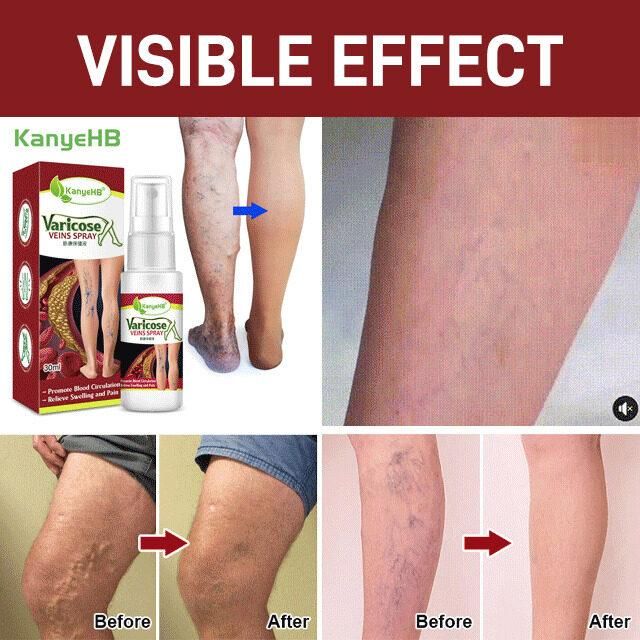 Varicose Veins Treatment Spray 🌿100% Herbal🌿