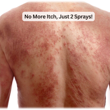 ItchXpert Anti Fungal Spray - Buy 1 Get 1 FREE