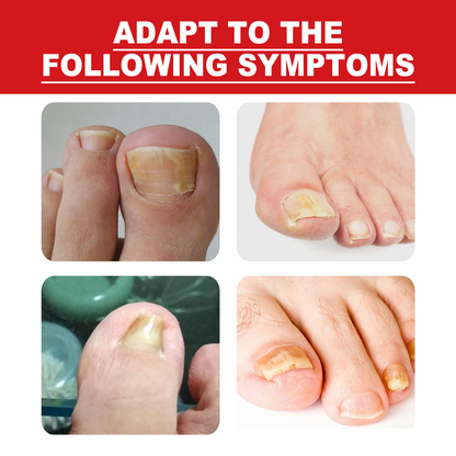 Toenail Drops Nail Repair Oil (BUY 1 GET 1 FREE🔥🔥)