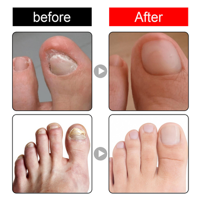 Toenail Drops Nail Repair Oil (BUY 1 GET 1 FREE🔥🔥)
