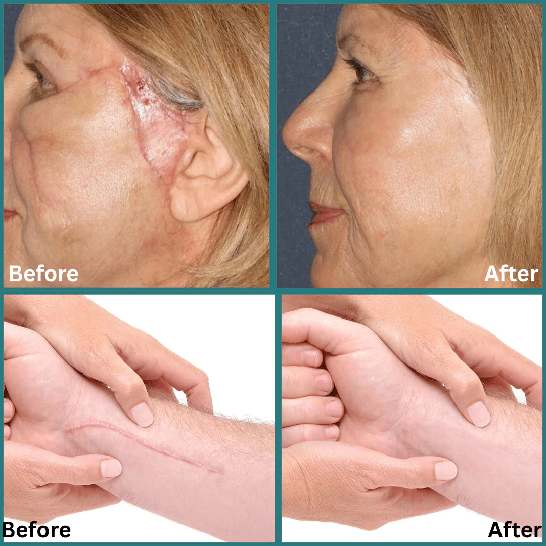 QB Scar Removal Spray - Say Goodbye to Scars Forever 🌟🌿