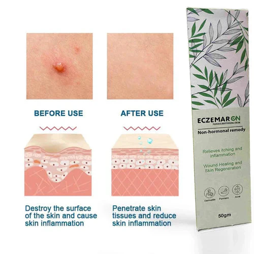 Eczemaron Anti-Fungal Spray - Instant Relief from Itching & Infection (Buy 1 Get 1 FREE🔥🔥)