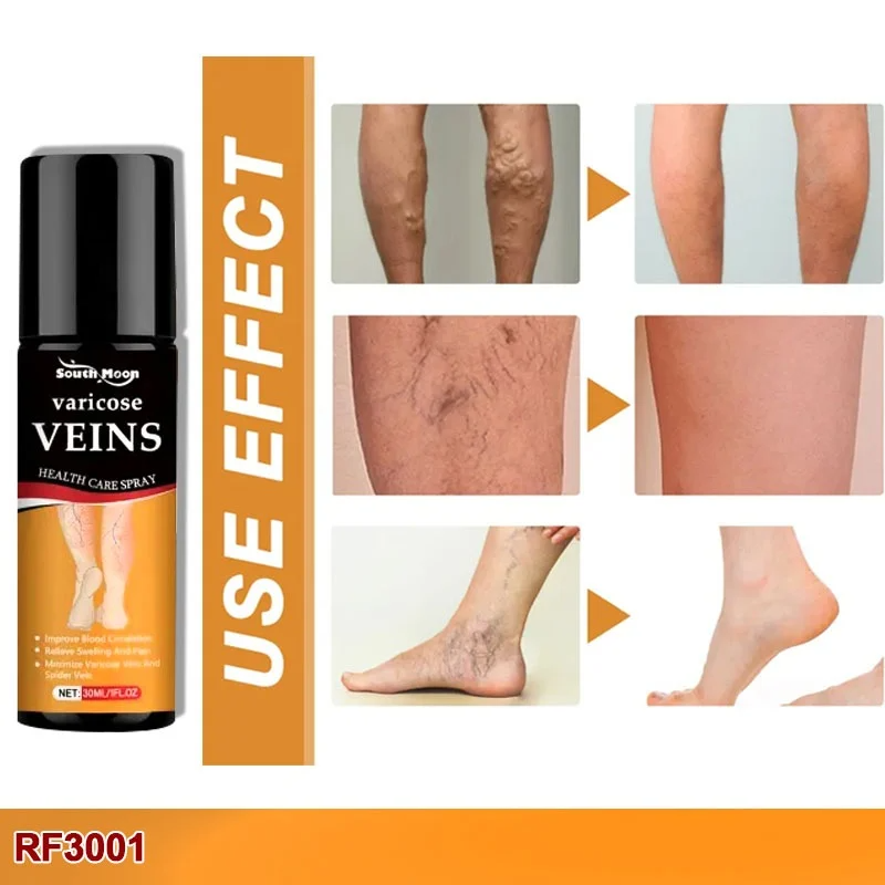Varicose Veins Relief Spray - (BUY 1 GET 1 FREE🔥🔥)