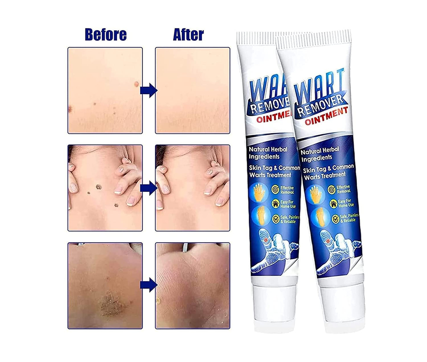 Instant Warts Remover Cream - 🔥Doctor's No 1 Choice🔥