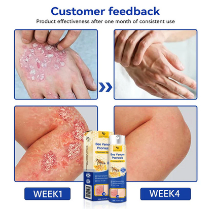 LOVILDS™ Anti Fungal Spray - BUY 1 GET 1 FREE