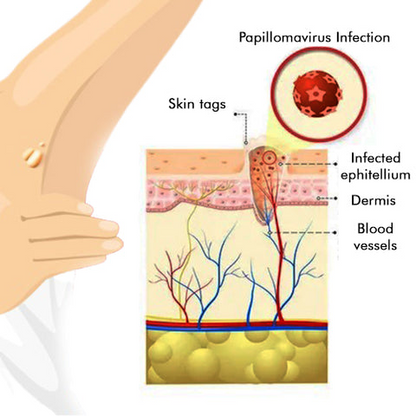 LOVILDS™ Warts & Tags Remover (Buy 1 Get 1 Free🔥🔥)