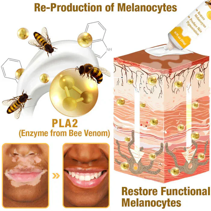 Bee Venom VitiGO Correcting Cream - Buy 1 Get 1 FREE🔥🔥