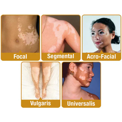 Bee Venom VitiGO Correcting Cream - Buy 1 Get 1 FREE🔥🔥