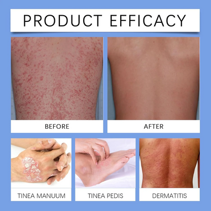 BeeVenom Psoriasis Treatment Spray