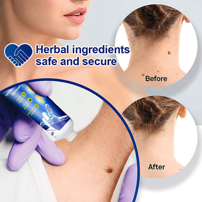 Instant Warts Remover Cream - 🔥Doctor's No 1 Choice🔥